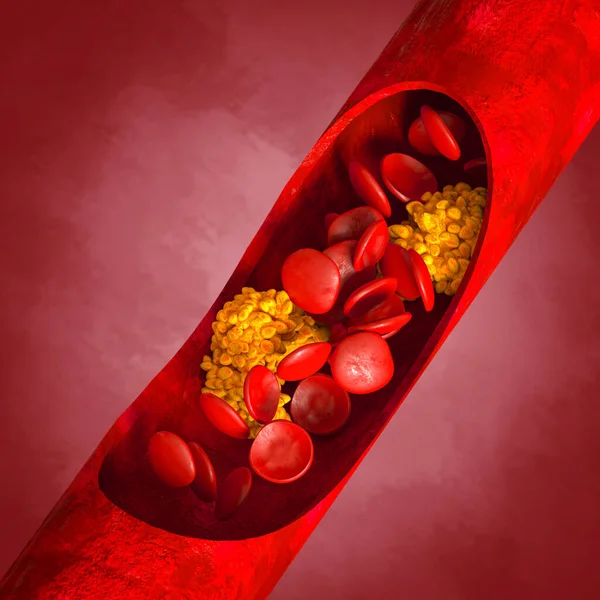 Antecedentes Médicos Placa Colesterol Arteria Aumento Del Nivel Ilustración — Foto de Stock