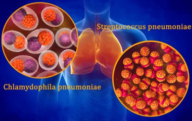 Tıbbi geçmiş, izole edilmiş solunum sistemine sahip insan bedeni, insan solunum patojenleri, Chlamydophila pnömoni, Streptococcus pneumoniae, zatürreeye neden olan bakteri, 3D görüntüleme.