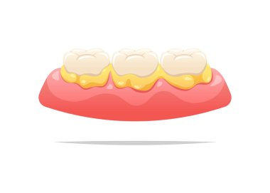 Diş ve diş etlerinde plaket var. Diş sağlığı konsepti. Vektör illüstrasyonu.