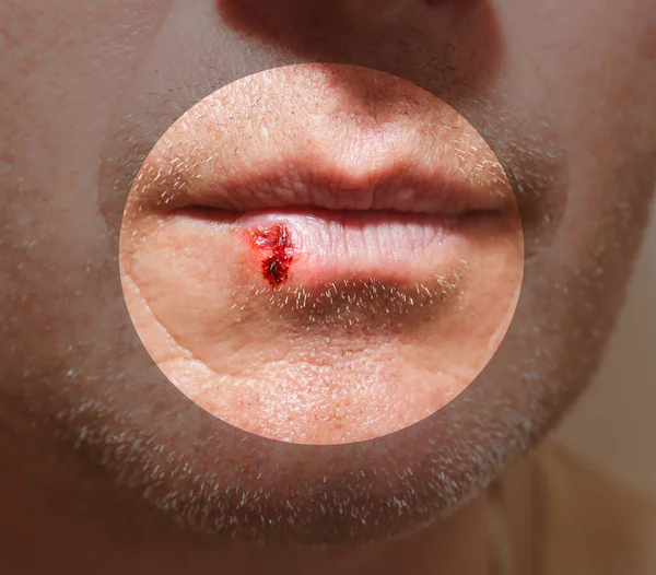 Herpes Infection Lips Wound Blood Man Face Medical Care Photo — Fotografia de Stock