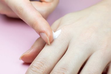 Woman applying hands cream. Irritated, problem skin of hands. Dermatology concept. Close up.