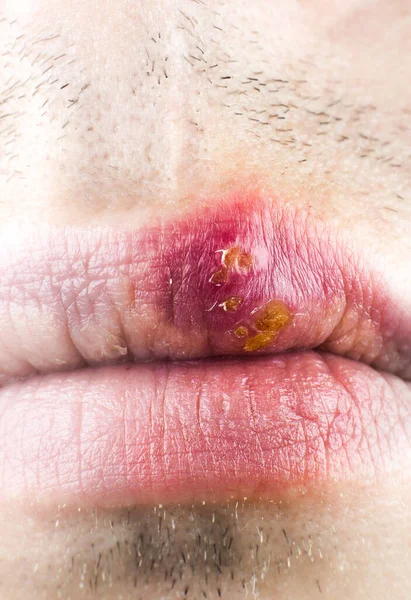 Herpes Labialis Lip Caucasian Man Face Close — Fotografia de Stock