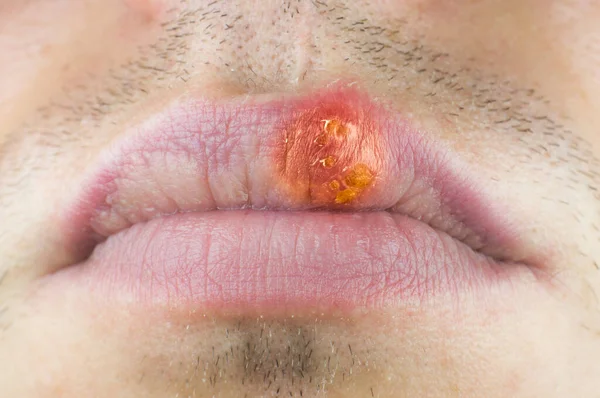 Herpes Labialis Lip Caucasian Man Face Close — Stock fotografie