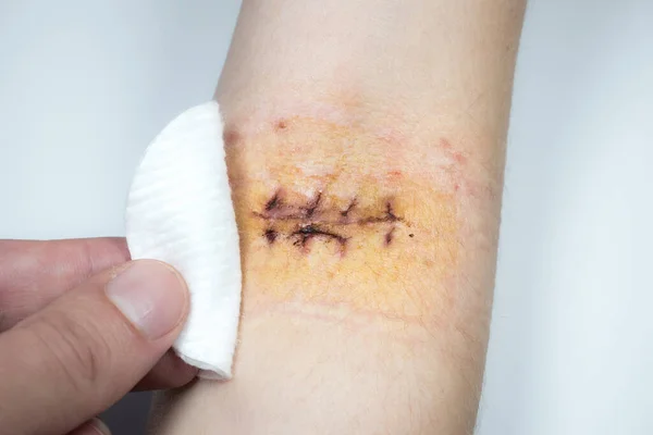 Disinfection of fresh scar on the hand after the surgery. Medical treatment disease photo.