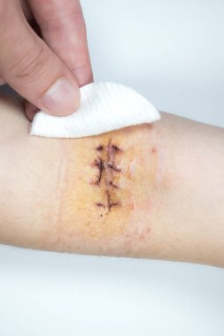 Disinfection of fresh scar on the hand after the surgery. Medical treatment disease photo.