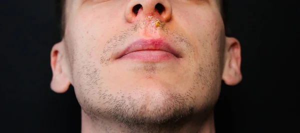 Herpes virus under the nose. Cold sore after the flu. Medical photo. Disease treatment.