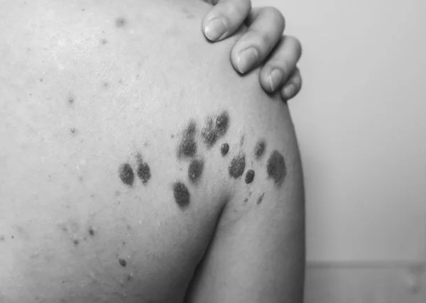 Big Birthmarks Freckles Girl Skin Medical Health Photo Back Woman — Stock Photo, Image