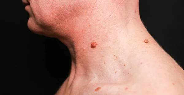 Big Birthmark Man Skin Medical Health Photo Papillomas Neck — 스톡 사진