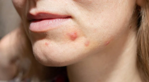 Piel Grasa Mujer Con Problemas Acné Cicatrices Heridas Cara Salud — Foto de Stock