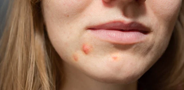 Woman\'s oily skin with acne problems. Scars and wounds on the face. Health care photo.