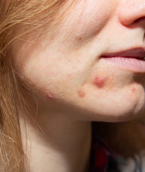Zsíros Bőre Akne Problémákkal Sebhelyek Sebek Arcon Egészségügyi Fotó — Stock Fotó