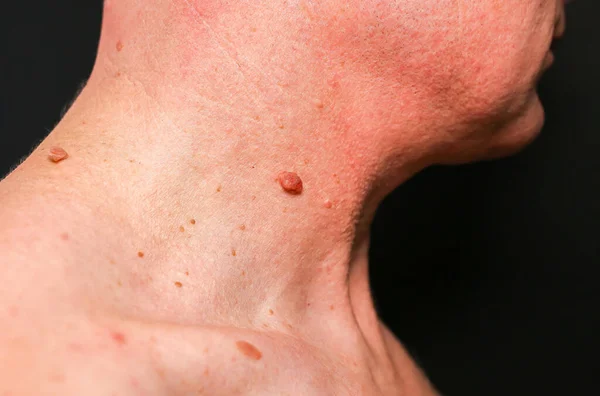 Big birthmark on the man\'s skin. Medical health photo. Papillomas on the neck.