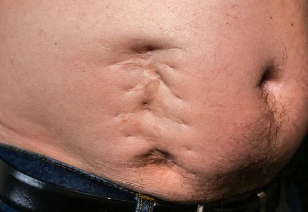 stock image Ugly bad scar on the man's fat belly after the appendicitis surgery. Old keloid on the stomach. Medical treatment disease photo.