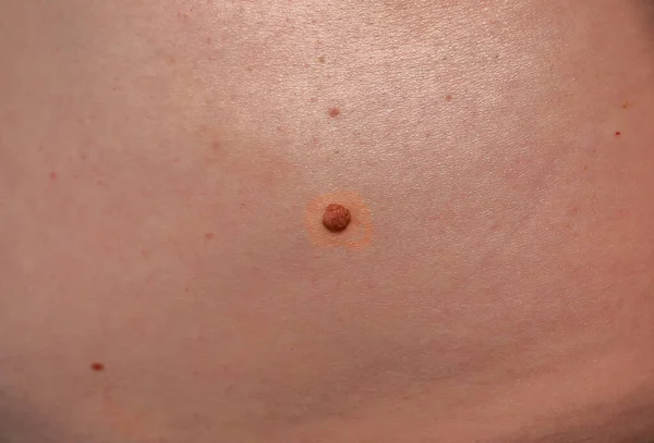 Big birthmark on the man\'s skin. Medical health photo.