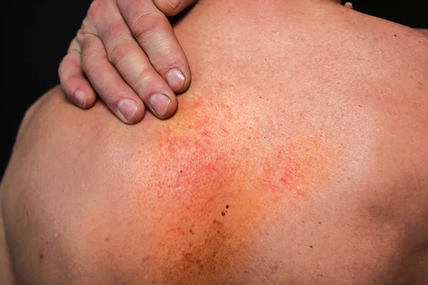 Alergická Vyrážka Zádech Toho Muže Lékařská Zdravotní Fotografie Olejnatá Pleť — Stock fotografie