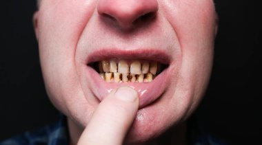 Adamın ağzında diş çürükleri ve paradontosis var. Diş çürümesi problemleri ve kötü bir gülümseme. Diş tedavisi konsepti.