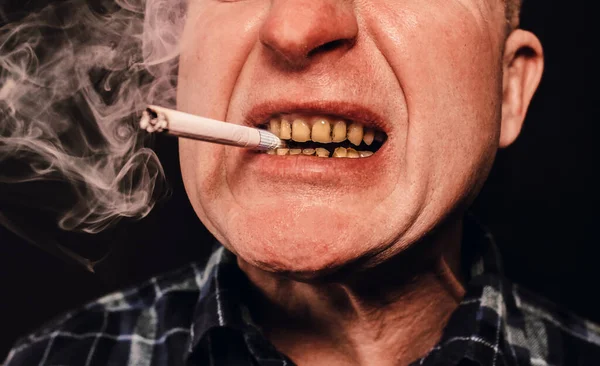 Une Cigarette Dans Bouche Homme Caries Des Dents Plaque Paradontose — Photo