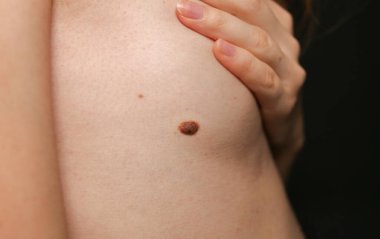 Kızın cildinde büyük bir doğum lekesi var. Sağlık fotoğrafı..