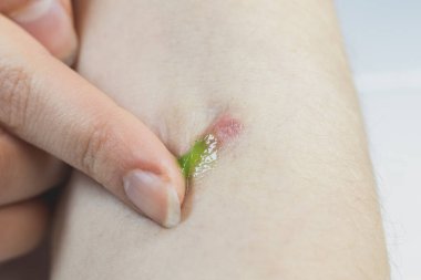 Kadın eline, iltihap kaynaklı tıbbi merhem sürüyor. Eline kaynar su şeklinde..