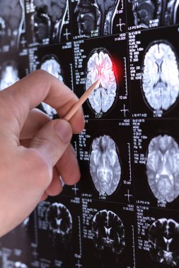 Bir doktorun dikey fotoğrafı MRI, MRT, insan beyninin tomografi görüntüsü. Tıbbi tedavi konsepti. İnsan kafasındaki hastalığın teşhisi. Kapat..