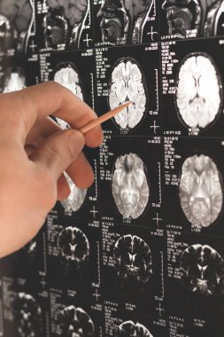 Bir doktorun dikey fotoğrafı MRI, MRT, insan beyninin tomografi görüntüsü. Tıbbi tedavi konsepti. İnsan kafasındaki hastalığın teşhisi. Kapat..