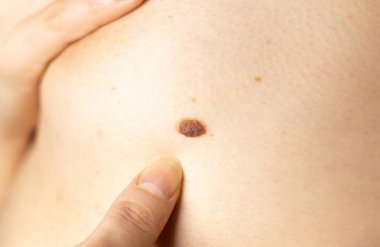 Kadının göğsünde büyük bir doğum lekesi var. Dermatoloji, sağlık hizmetleri. Tıbbi tedavi.