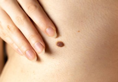 Kadının göğsünde büyük bir doğum lekesi var. Dermatoloji, sağlık hizmetleri. Tıbbi tedavi.