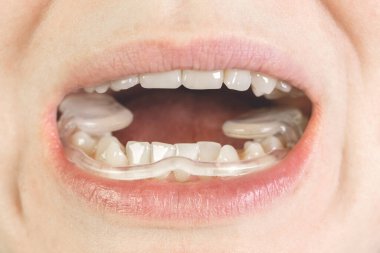 Kadın TMJ için yumuşak ağız koruyucusu, ağzına TMD koyuyor. Diş koruması. Dişçi. TMJ bozukluğu. Çene ağrısı. Diş gıcırdatma.
