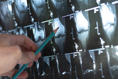 Doktor kemik diz tümörünü inceliyor. Röntgen, MR, MR, skleroz işaretli tomografi. Tıbbi tedavi konsepti. Hastalığın teşhisi insan kemikleri..