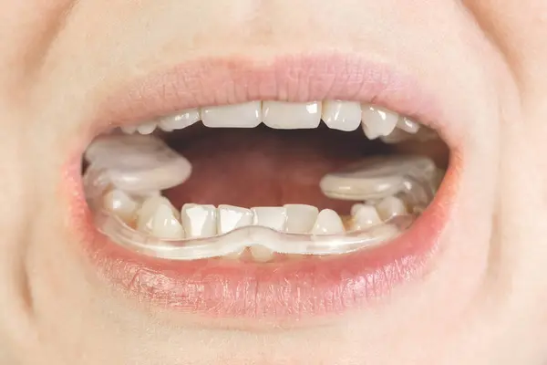 Kadın TMJ için yumuşak ağız koruyucusu, ağzına TMD koyuyor. Diş koruması. Dişçi. TMJ bozukluğu. Çene ağrısı. Diş gıcırdatma.