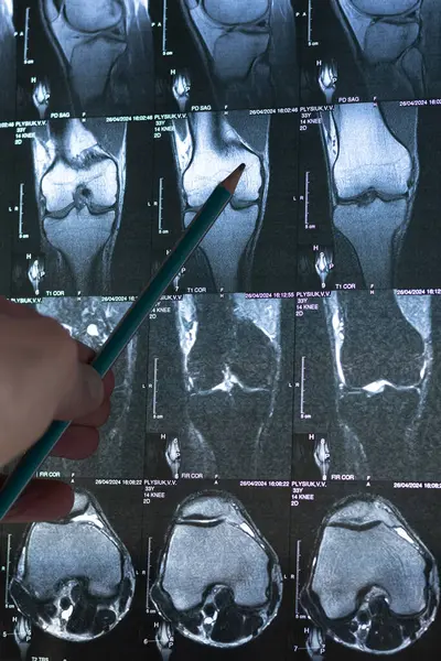 stock image Doctor examining bone knee tumor. X-ray and MRI, MRT, CT with marked sclerosis around the nidus. Medical treatmant concept. Diagnosis of the disease humans bones.