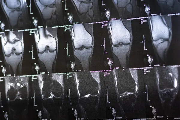 stock image Bone knee tumor. X-ray and MRI, MRT, CT with marked sclerosis around the nidus. Medical treatment concept. Diagnosis of the disease humans bones.