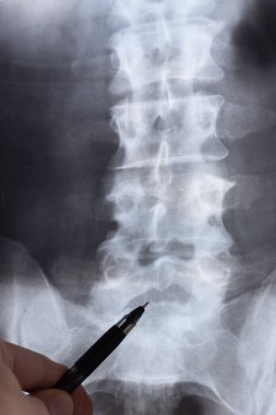 Doktor röntgen ve MR 'ı, MRT' yi, insan omurgasında kemik ve omurga kusurları olan tomografiyi inceliyor. Tıbbi tedavi konsepti. Omurga, kalça eklemi ve omurlar arası fıtık teşhisi.