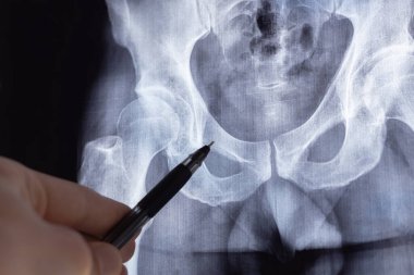 Doktor röntgen ve MR 'ı, MRT' yi, insan omurgasında kemik ve omurga kusurları olan tomografiyi inceliyor. Tıbbi tedavi konsepti. Omurga, kalça eklemi ve omurlar arası fıtık teşhisi.