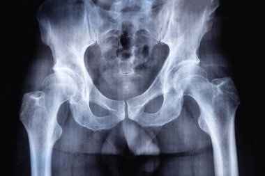 Röntgen ve MRI, MRT, insan omurgasında kemik ve omurga hasarı olan tomografi. Tıbbi tedavi konsepti. Omurga, kalça eklemi ve omurlar arası fıtık teşhisi.