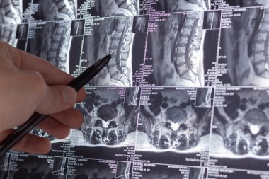 Doktor röntgen ve MR 'ı, MRT' yi, insan omurgasında kemik ve omurga kusurları olan tomografiyi inceliyor. Tıbbi tedavi konsepti. Omurga, kalça eklemi ve omurlar arası fıtık teşhisi.