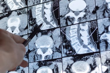 Doktor röntgen ve MR 'ı, MRT' yi, insan omurgasında kemik ve omurga kusurları olan tomografiyi inceliyor. Tıbbi tedavi konsepti. Omurga, kalça eklemi ve omurlar arası fıtık teşhisi.