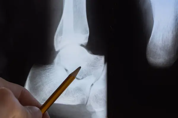 stock image Doctor examining X-ray scan of Calcaneus or heel bone destruction. Bone of the tarsus of the foot. Medical treatment concept. Diagnosis of the disease humans bones.