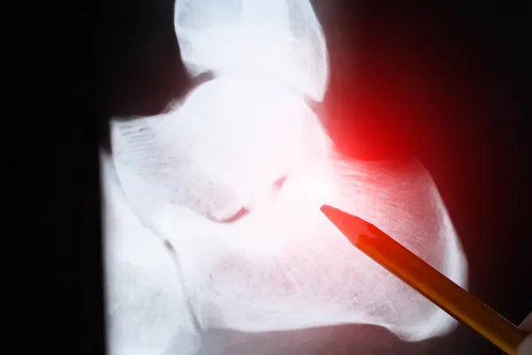 stock image Doctor examining X-ray scan of Calcaneus or heel bone destruction. Bone of the tarsus of the foot. Medical treatment concept. Diagnosis of the disease humans bones.