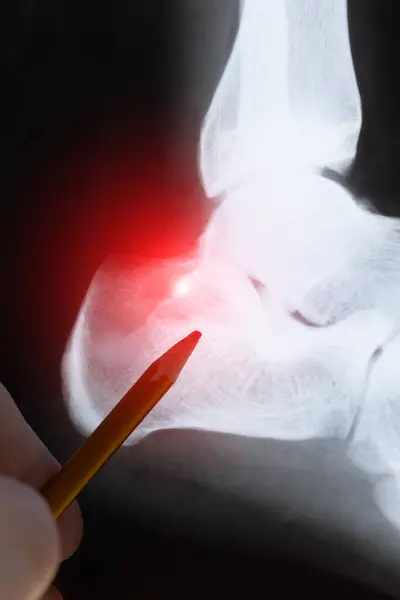 stock image Doctor examining X-ray scan of Calcaneus or heel bone destruction. Bone of the tarsus of the foot. Medical treatment concept. Diagnosis of the disease humans bones.