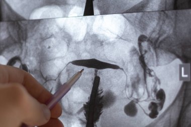 Histerosalpingografinin (HSG) röntgen görüntüsünü inceleyen doktor. Kontrastlı MR. Rahim tüpleri, kadın üreme sistemini analiz ediyor. Kısırlık tedavisi.