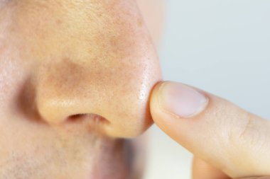 Siyah noktalar erkeklerin burnunda. Sivilce sorunu, boşalma sorunu. Kapat..