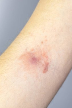 Dikey iltihaplı apse, tahriş ve kadının elinde deri iltihabı. Stafilokok iltihabı. Yakın çekim, tıbbi fotoğraf..