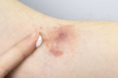 Elindeki iltihap ve dermatitle iltihaplı apseden sağlık kremi süren bir kadın. Stafilokok iltihabı. Yakın çekim, tıbbi fotoğraf..