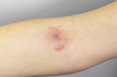 Kızarıklık ve deri iltihabı olan iltihaplı bir apse. Stafilokok iltihabı. Yakın çekim, tıbbi fotoğraf..