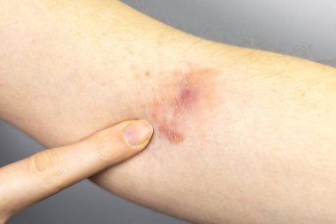 Elindeki deri iltihabı ve iltihaplı iltihaplı bir kadın. Stafilokok iltihabı. Yakın çekim, tıbbi fotoğraf..