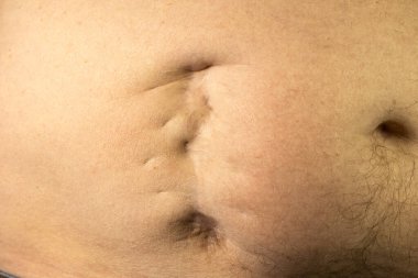 Apandisit ameliyatından sonra adamın göbeğinde çok kötü bir yara izi var. Midesinde eski keloid izi var. Tıbbi tedavi fotoğrafı..