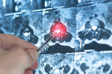 Omurgadaki fıtıklaşmış omurilik diskinin MRI 'sı incelensin..