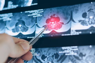 Omurgadaki fıtıklaşmış omurilik diskinin MRI 'sı incelensin..