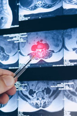 Omurgadaki fıtıklaşmış omurilik diskinin dikey MRI incelemesi, x-ray görünümünü kapatın.